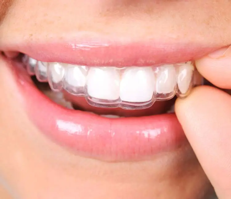 Detailaufnahme Invisalign: Eingesetzte Zahnschiene am Oberkiefer