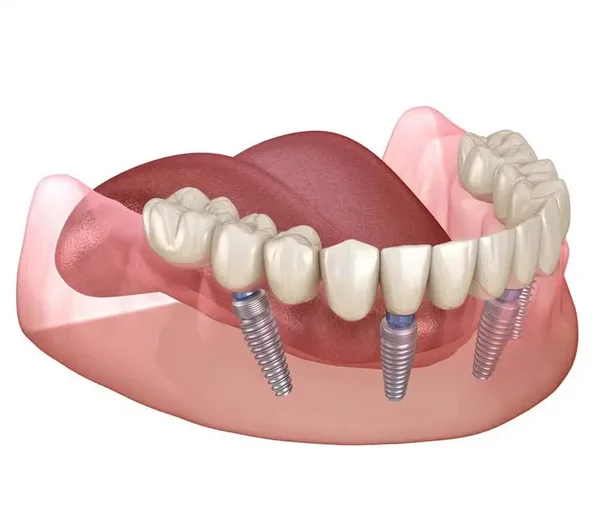 3D-Darstellung einer festen Br&uuml;cke im Unterkiefer, die auf vier Implantaten befestigt ist.