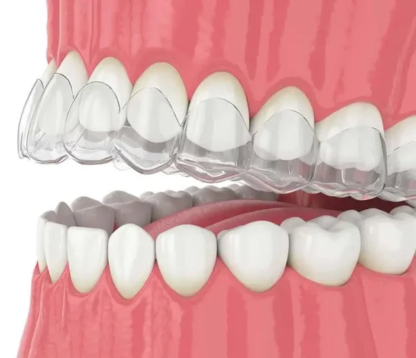 3D-Darstellung einer transparenten Invisalign-Schiene, die passgenau &uuml;ber die Z&auml;hne gesetzt wird